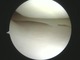 this is what a normal meniscus looks like. it is the white structure oriented horizontally in the image from roughly 9:00 to 3:00